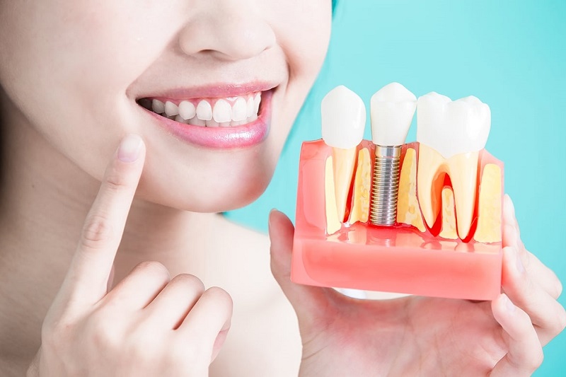 Trồng răng không thuộc vào hạng mục được hưởng quyền lợi từ bảo hiểm y tế