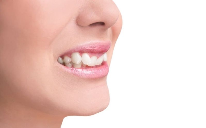 Răng khểnh là răng nanh mọc lệch, có xu hướng mọc nhô ra phía trước