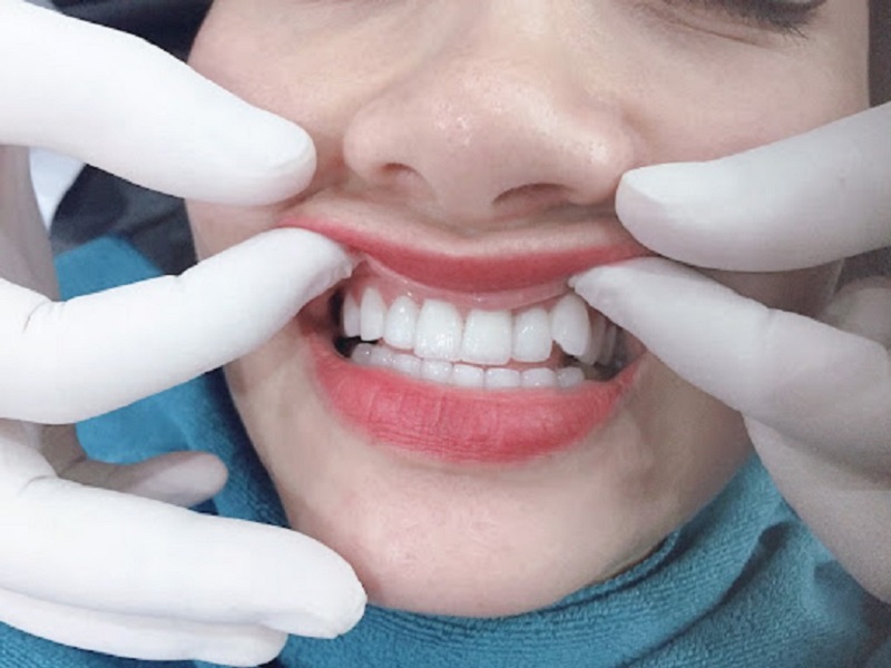 Bọc sứ cho răng khểnh giúp răng hài hòa, khớp cắn ổn định
