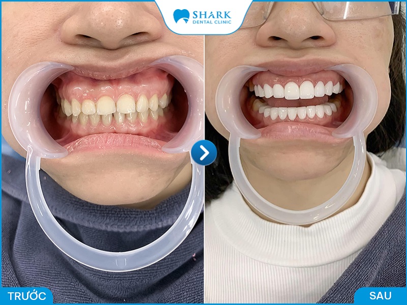 Hình ảnh khách hàng trước và sau khi bọc răng sứ tại nha khoa Shark