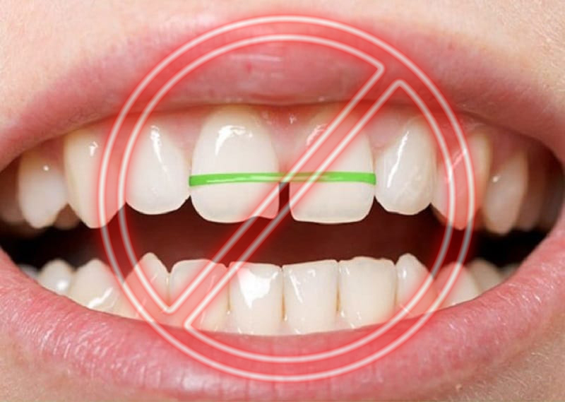 Cách làm răng thưa khít lại tại nhà có thể gây nên các hậu quả nghiêm trọng