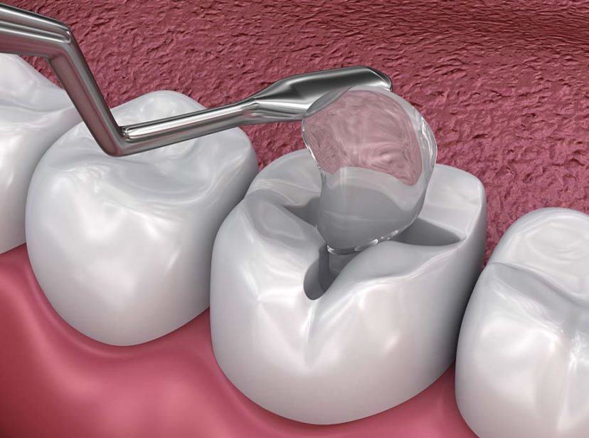 Hàn trám sử dụng chất liệu Composite chuyên dụng, giúp bù đắp phần mô răng khuyết thiếu