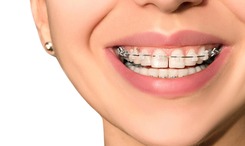 Niềng răng là giải pháp được các bác sĩ xác nhận tính hiệu quả và an toàn trên mọi phương diện