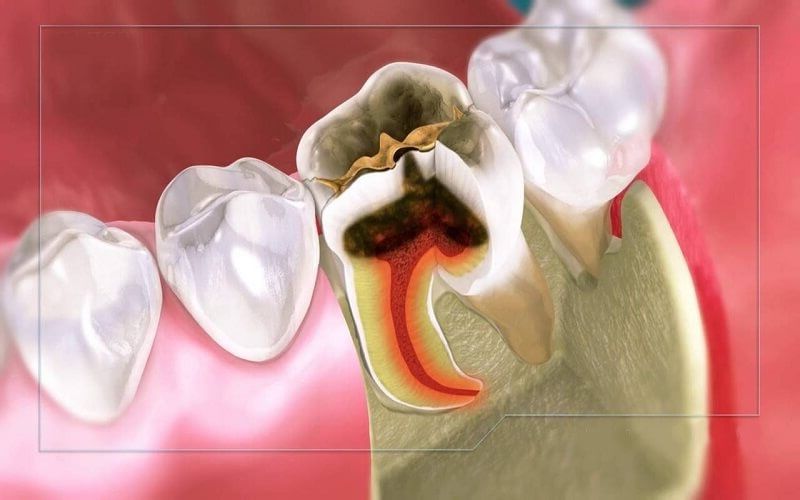 Thuốc giảm đau sẽ được các bác sĩ chỉ định sử dụng trong những trường hợp cơn đau răng đặc biệt nghiêm trọng
