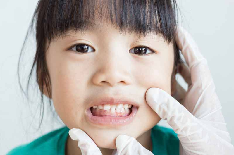 Phụ huynh cần chú ý đến sự phát triển của răng sữa và răng vĩnh viễn để hỗ trợ quá trình thay răng ở bé diễn ra thuận lợi