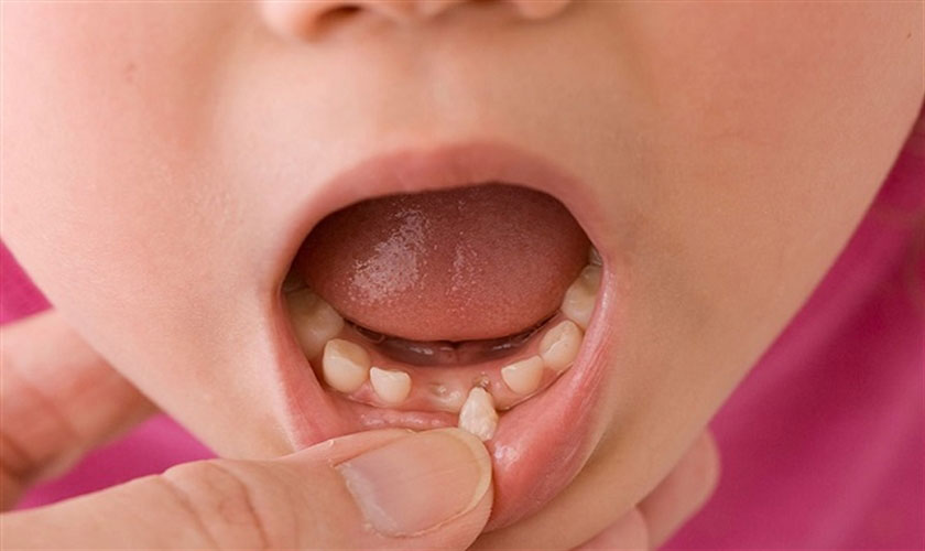 Nhổ răng sữa tại thời điểm không thích hợp có thể gây nên một số vấn đề nghiêm trọng về sức khỏe răng miệng cho bé