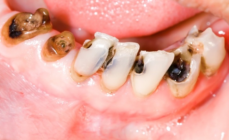 Sâu răng là nguyên nhân gây nhức răng dễ mắc phải nhất