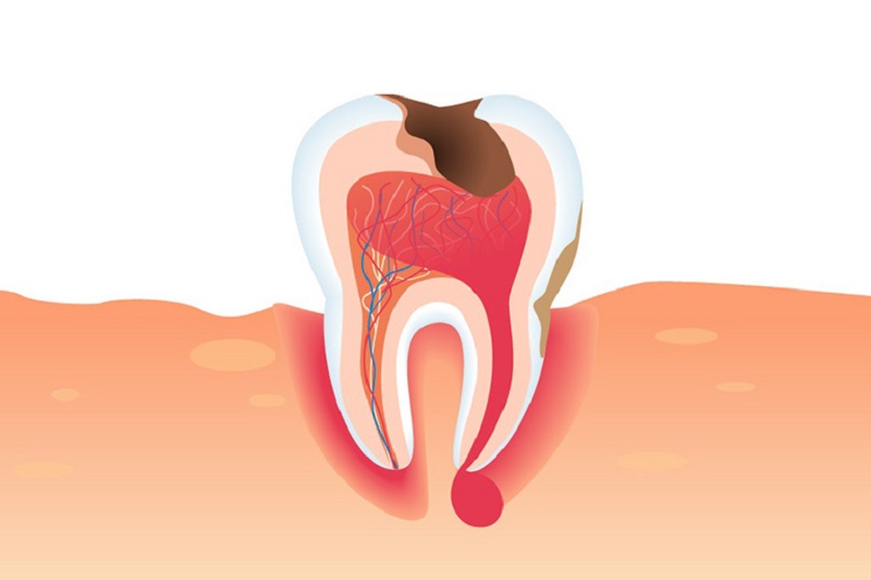 Áp xe răng là nguyên nhân gân nên hiện tượng nhức răng