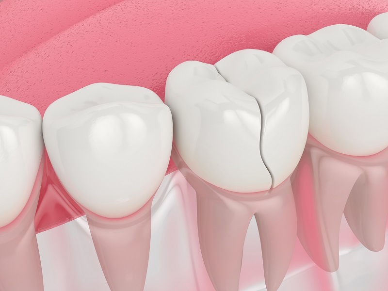 Khi chấn thương qua mạnh lực cắn và nhai có thể khiến cho răng suy yếu và gây đau nhức