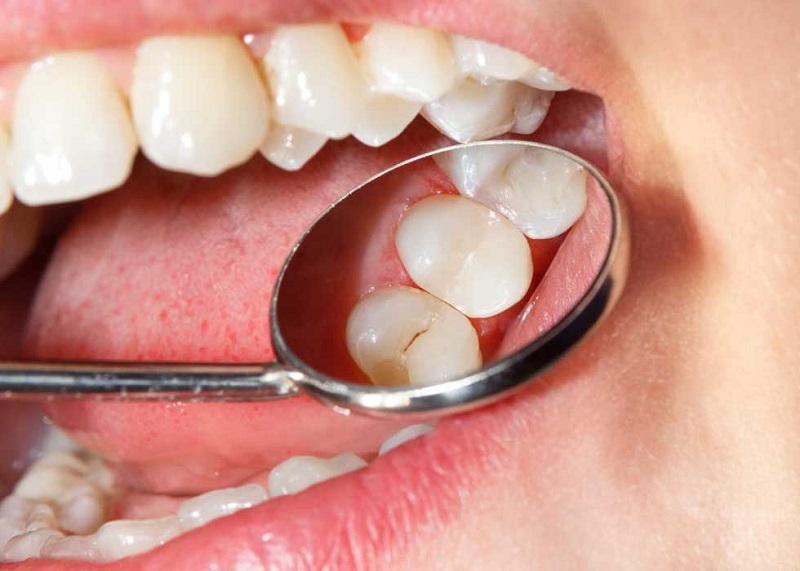 Trám răng là giải pháp điều trị đối với nguyên nhân gây nhức răng do răng chấn thương, nứt vỡ