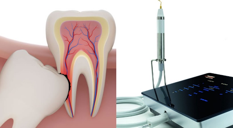 Nhổ răng khôn bằng công nghệ Piezotome 