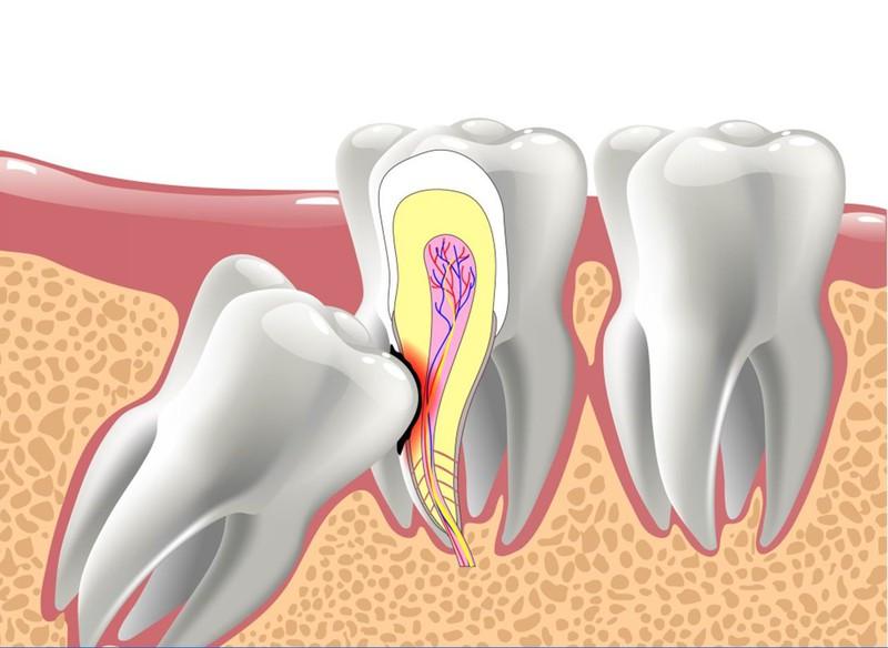 Răng khôn thường mọc ngầm vào trong xương hàm và đâm vào răng số 7, khiến răng số 7 lung lay, gãy vỡ hoặc rụng vĩnh viễn