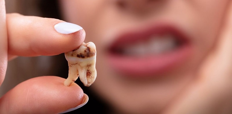 Nhổ 4 răng khôn cùng lúc sẽ thực hiện được nếu đầy đủ sức khoẻ