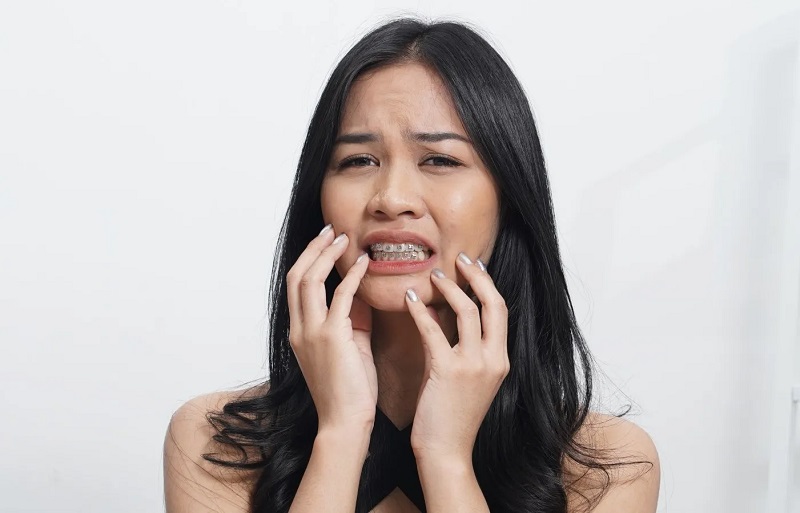 Nguyên nhân niềng răng bị hở chân răng và khắc phục như thế nào?