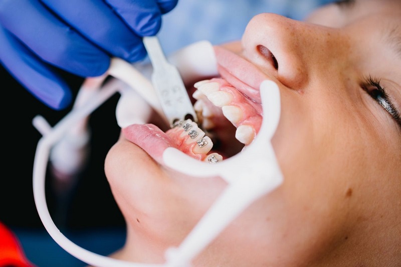 Kỹ thuật thực hiện của bác sĩ nha khoa trong quy trình niềng răng đóng vai trò rất quan trọng