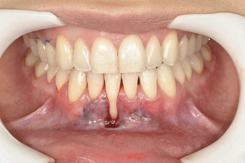 Tụt chân răng làm ảnh hưởng đến sức khoẻ răng miệng