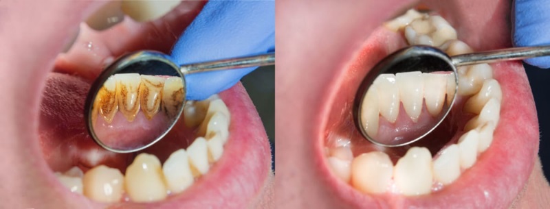 Cạo vôi răng định kỳ để khắc phục tình trạng niềng răng hở chân răng
