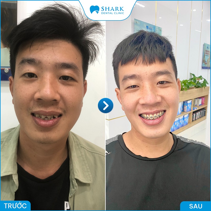 Hình ảnh khách hàng trước và sau khi niềng răng tại nha khoa Shark