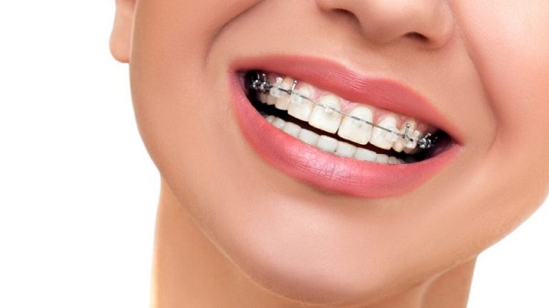 Niềng răng có làm môi bớt dày không?