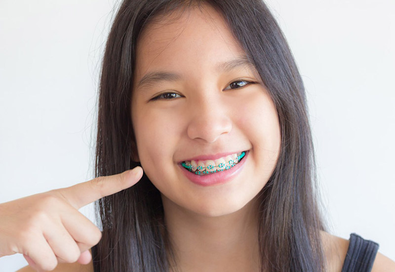 Niềng răng là kỹ thuật chỉnh nha giúp khuôn răng đều đặn và thẩm mỹ hơn, hỗ trợ khớp cắn giữa 2 hàm răng chuẩn tỷ lệ