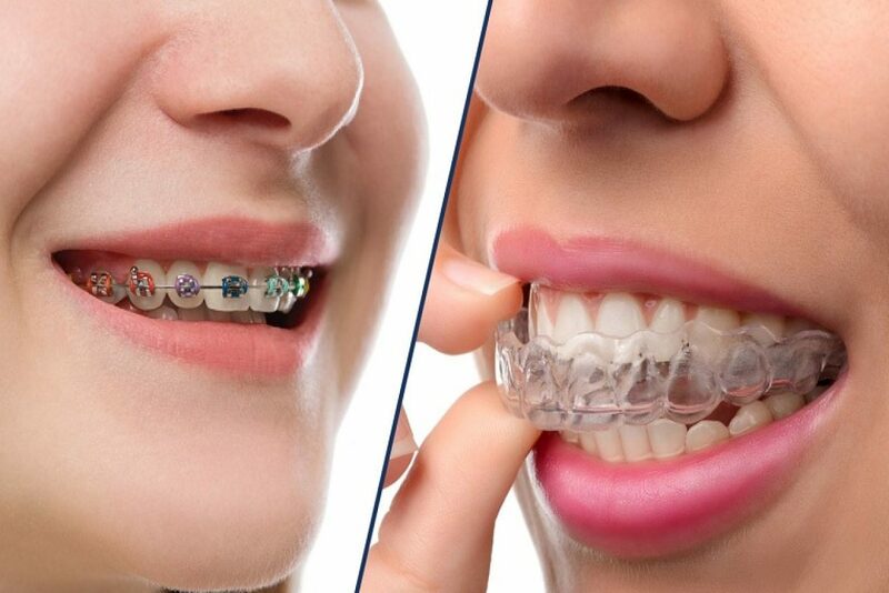 Để cải thiện tình trạng môi dày, bạn có thể áp dụng 2 phương pháp chính: Niềng răng sử dụng mắc cài và niềng răng không sử dụng mắc cài