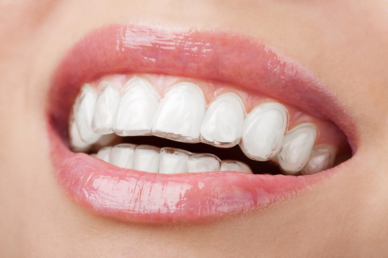 Niềng răng trong suốt mang thương hiệu Leetray sẽ giúp dịch chuyển răng không gây đau đớn, khó chịu