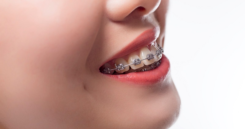 Niềng răng xong bị hô trở lại là vấn đề khiến mọi người lo lắng trước khi chỉnh nha
