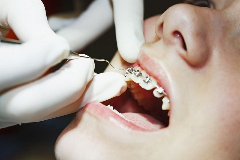 Lực siết răng không đúng cách sẽ ảnh hưởng đến kết quả niềng răng