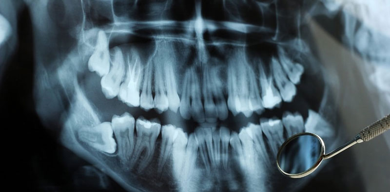 Xác định sai tình trạng răng là nguyên nhân gây nên niềng răng xong bị hô lại
