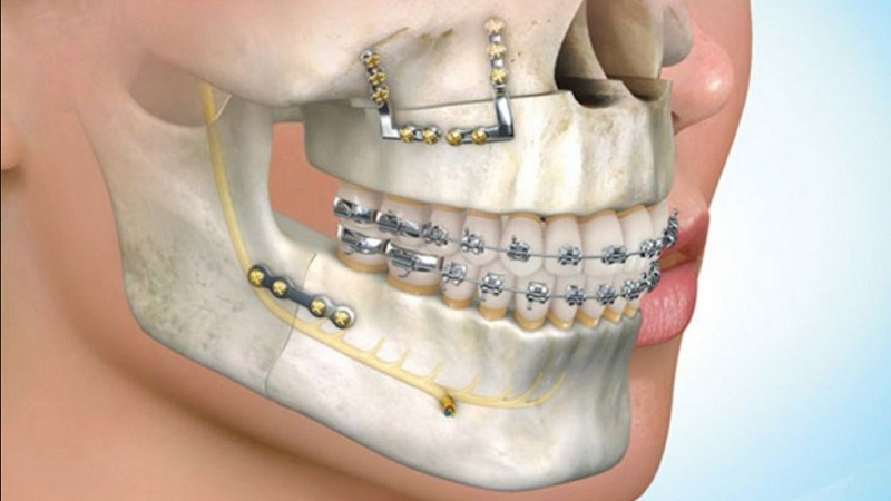 Phẫu thuật hô hàm và niềng răng 