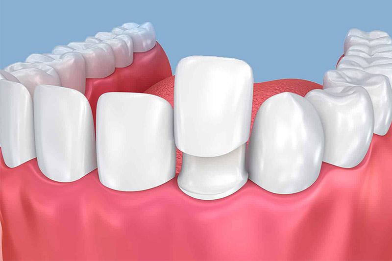 Răng tạm khi làm răng sứ là gì? Vì sao cần thực hiện?