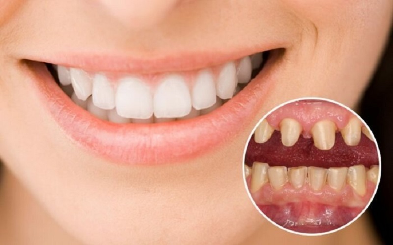 Lắp mão răng tạm sẽ giúp bạn duy trì tính thẩm mỹ của hàm răng