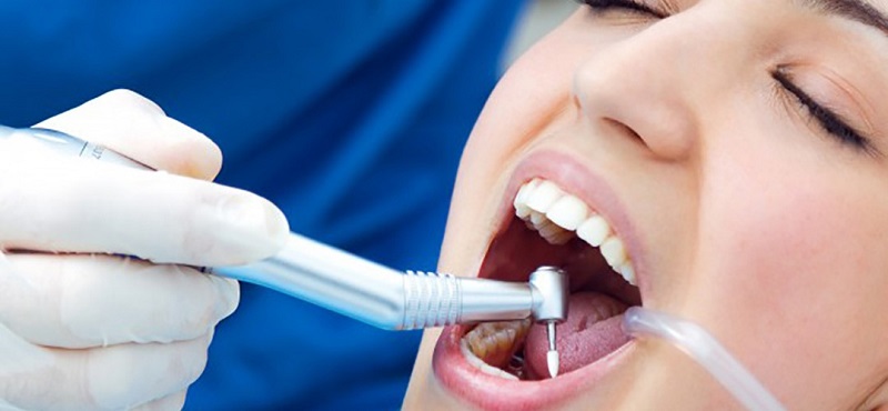 Cần vệ sinh răng sạch sẽ trước khi gắn răng