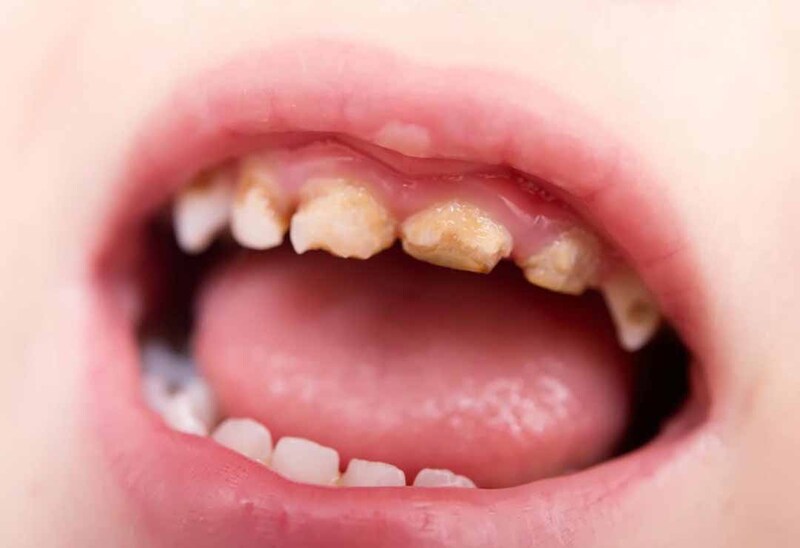 Răng trẻ bị trắng đục làm ảnh hưởng đến tính thẩm mỹ của hàm răng