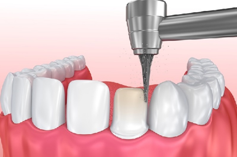 Mài men răng vi điểm giúp giảm thiểu đáng kể các đốm trắng trên răng trẻ