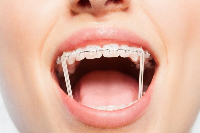 Siết răng khi niềng răng là gì? Thực hiện như thế nào?