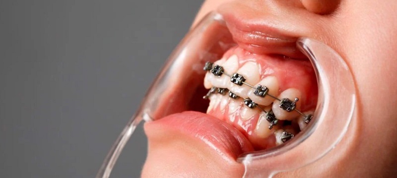 Siết răng trong khi niềng là cách thức tốt nhất và nhanh nhất theo đánh giá của các bác sĩ nha khoa để tăng hiệu quả chỉnh nha