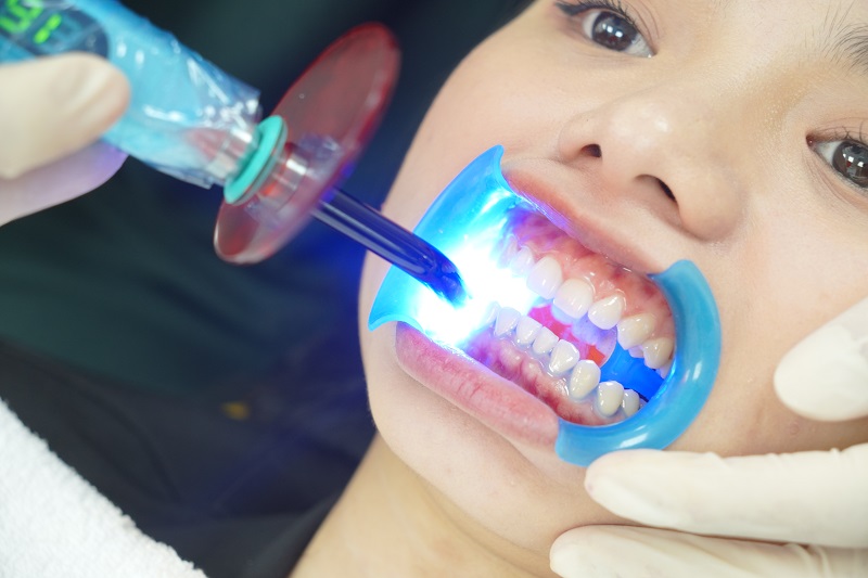 Tẩy trắng răng tại nha khoa an toàn