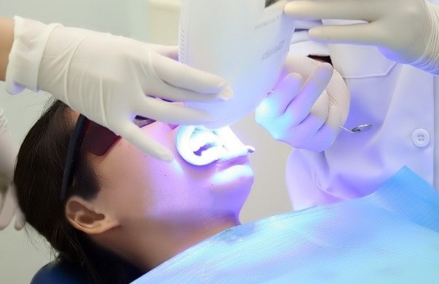 Tẩy trắng răng tại các phòng khám nha khoa uy tín
