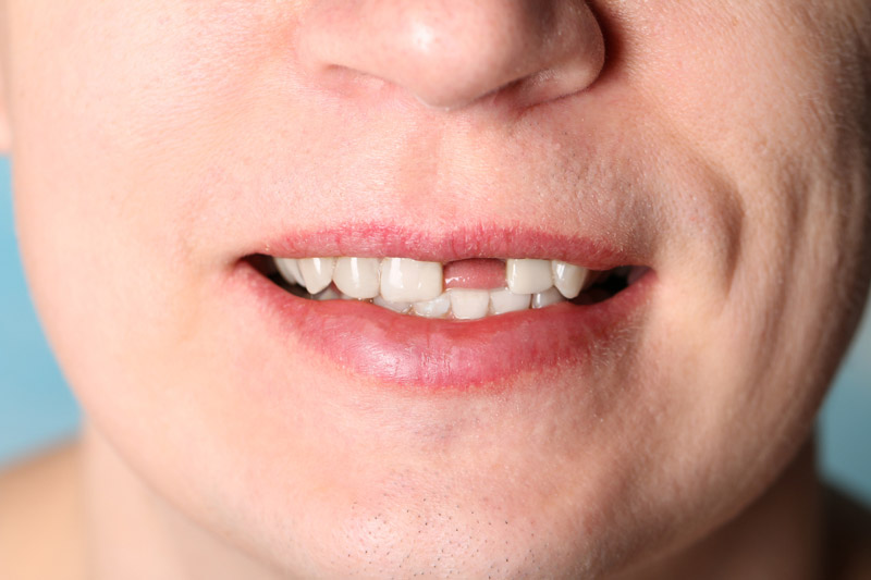 Thiếu răng có niềng răng được không?
