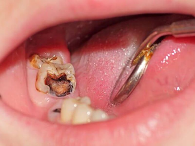Vị trí sâu răng càng phức tạp có chi phí chữa trị càng cao