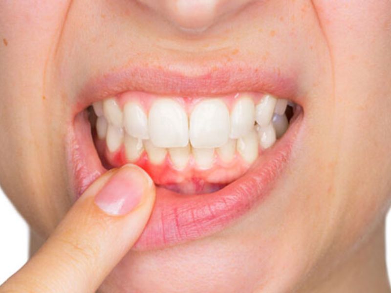 Các bệnh lý về răng miệng như sâu răng, viêm nướu,... là nguyên nhân gây ra hơi thở có mùi