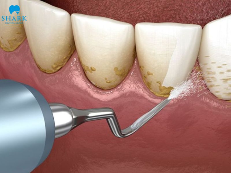 Bọc răng sứ không cần lấy cao răng định kỳ