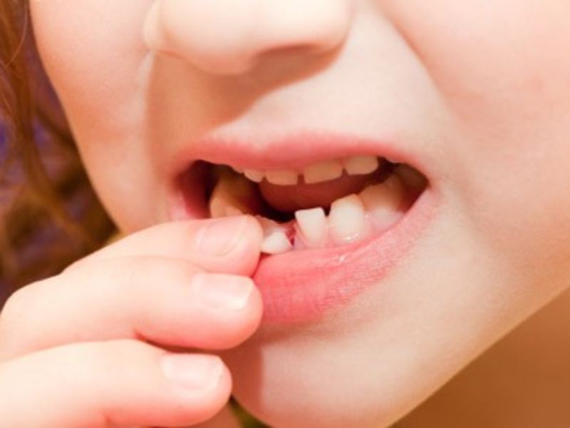 Dùng lưỡi để đẩy giúp răng lung lay và rụng nhanh chóng