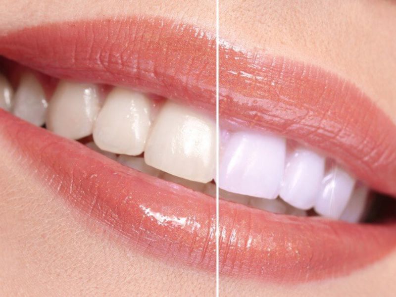 Những trường hợp răng bị xỉn màu do tuổi tác có thể áp dụng phương pháp tẩy trắng răng bằng máng