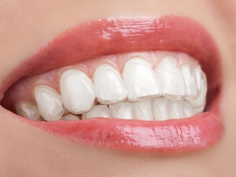 Sử dụng máng giúp tẩy trắng răng nhanh chóng và đạt hiệu quả như mong muốn