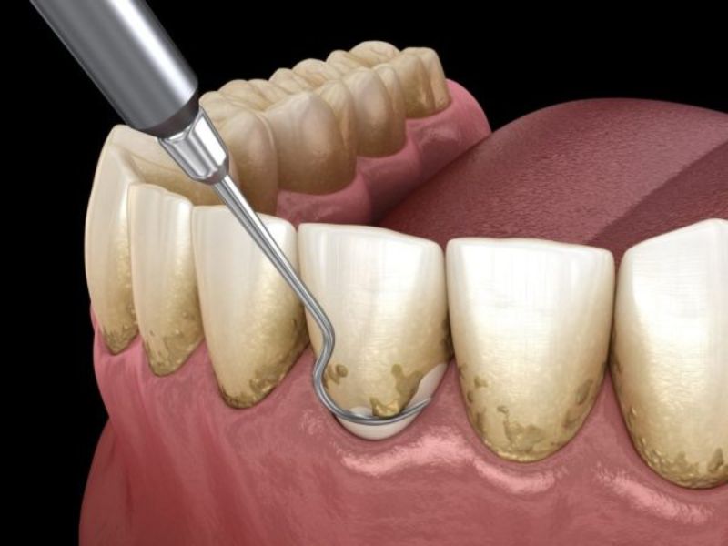 Thời gian lấy vôi răng kéo dài khoản từ 15 - 30 phút