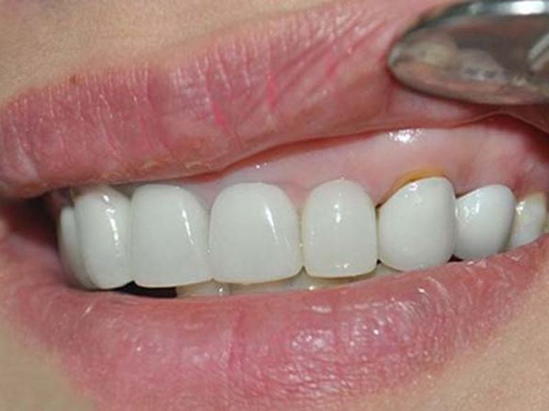 Nguyên nhân nào gây nên tình trạng chân răng bị đen