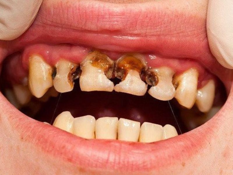 Sâu răng khi để lâu sẽ làm phần ngà răng chuyển sang màu đen