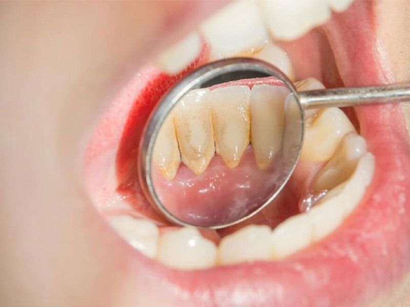 Tình trạng chân răng bị đen để lâu sẽ gây ảnh hưởng tới sức khỏe răng miệng